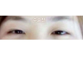수술 전