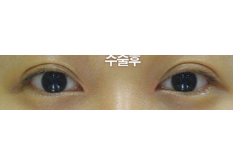 수술 후