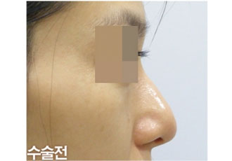 수술 전