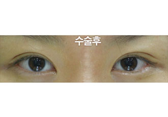 수술 후