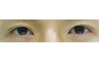 수술 후