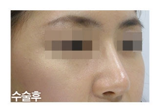 수술 후