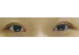 수술 후