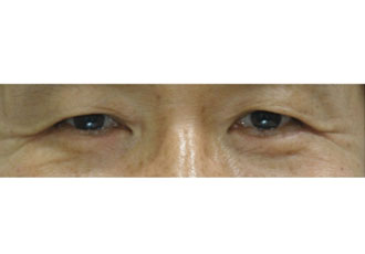 수술 후