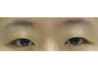 수술 전