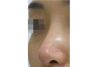 수술 후