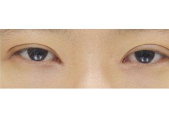 수술 후
